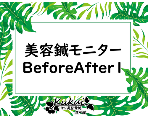 美容鍼モニターBeforeAfter１